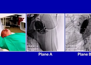 मस्तिष्कमा रगत जम्ने रोग ब्रेन एभीएमको केएमसी दुवाकोटमा बिनाचिरफार उपचार